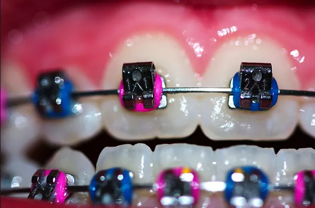 Brackets de Colores para Mejorar la Sonrisa